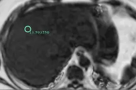 杭州23岁女孩”魔鬼式“减肥3个月，体重降了15斤，为何减出脂肪肝？图片