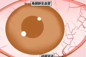热搜第一！不建议戴美瞳，真的是为你好图片