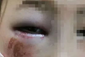 8岁小学生算错题遭老师殴打险致失明？官方：看视频判断是手误，涉事教师已停职图片