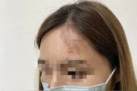 心理培训师注射胶原蛋白美容“毁脸”医院：属小概率并发症 赔偿未达成一致图片