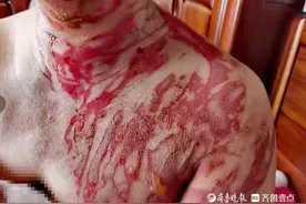 找记者上壹点丨女子拔罐被二度烧伤，涉事美容馆拒赔：狮子大开口图片