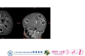 4岁男孩颅内八个脑脓肿最大如鸡蛋，医生2次脑内“拆弹”图片
