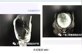 年轻女子腹部隆起误认为怀孕6月？这个女性疾病常见莫忽视图片