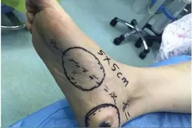 黑痣突然长大 或是恶性黑色素瘤图片