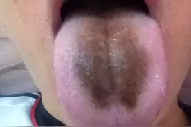 舌苔发黑可不是好事，或与这5个因素密切相关，千万要重视图片