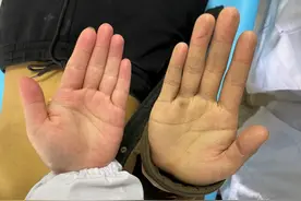 长沙70岁爷爷服用“神医”祖传保健药后面色发黄，专家提醒：滥用药物恐引起肝损伤图片