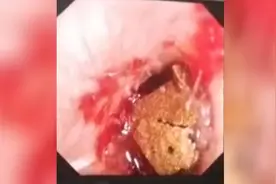 103秒丨六岁女童模仿孙悟空 把“钻石”塞进耳内竟达两年之久图片