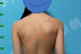 脊柱侧弯了解一下（二）图片