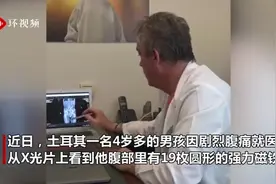 土耳其小男孩吞19枚强力磁铁 将肠道黏一起引腹痛图片