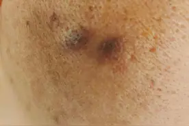 业绩不好被老总烟头烫脸？伤者：老总事后说酒后行为，要求和解被拒图片