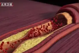 血管发生这种变化，可能比狭窄更可怕！忽视这些“日常杀手”，难怪容易得冠心病……图片