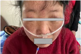 脚上一按一个坑！五旬大妈心上长了层“铠甲”，看医生如何化险为夷图片