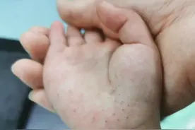 想想都疼！3岁女童一掌拍向仙人球成“刺猬手”，最深扎进皮下5毫米图片