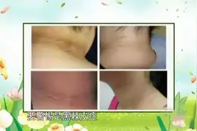 身体出现这些纹路，多是疾病征兆图片