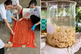 泰国一男子爱吃生牛肉，体内取出18米长寄生虫！还有28颗虫卵图片