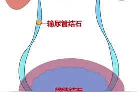 你还不爱喝水吗？这种病疼起来像刀割，越来越多年轻人中招图片