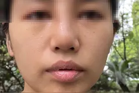 花两万多元贷款分期做的鼻子却歪了？美容机构：只能修复，退3000元图片