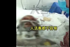 女子遭男友泼汽油烧伤后再发声：死刑不至于，人活着都不容易图片