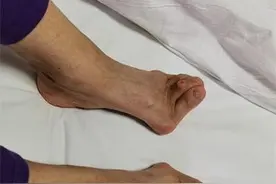 鞋子从37码穿到40码，姐妹俩拐了弯的脚趾正了回来图片