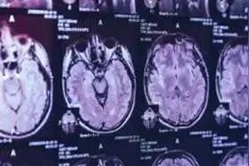 加拿大出现不明脑部疾病 超过40人染病5人死亡视频封面