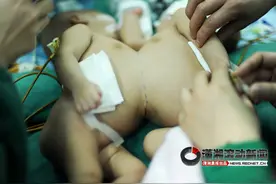 愚人节这天分离，同时也创造了奇迹！湖南首例连体双胞胎12岁了图片