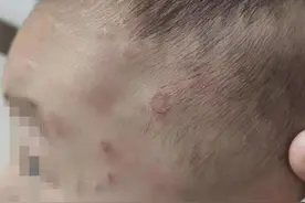 枕着猫咪一起睡觉，清远3岁幼童感染猫藓图片
