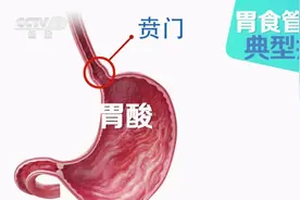 常常饭后“烧心”？千万不要掉以轻心图片