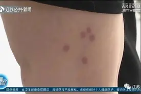 17岁姑娘出现“致命红斑”！此地1死26伤！紧急提醒：清明出游多地有人中招图片