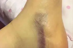 没磕没碰，为何身上总有淤青？或许与这些原因有关系，别忽视图片