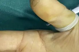 杀伤力惊人！女子手上长出瘤，一张破碎手机膜把她坑惨！网友吓懵图片