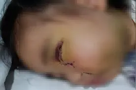 3岁女孩度假村游玩被马咬伤 妈妈：眼睛、鼻、嘴变形，准备小学时整形图片