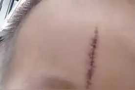 男童幼儿园磕破头缝了十来针，家长与园方协商两年未果图片