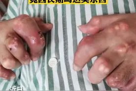 触目惊心！27岁小伙双手长满痛风石，患病原因值得警惕图片