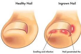 脚趾甲老长进肉里，怎么办？图片
