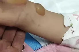 4岁半女儿被热汤严重烫伤 单亲妈妈无奈求助图片