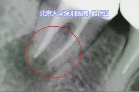 拔下来的坏牙再种回去“活了”！北大深圳医院医生巧手留住天然牙图片