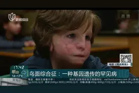 鸟面综合征：一种基因遗传的罕见病