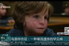 鸟面综合征：一种基因遗传的罕见病视频封面