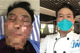 惊险！昆明一男子用强碱疏通下水道 碱水入眼烧伤角膜图片