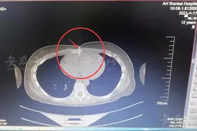 惊险！4厘米汽钉射入男孩心脏！事发宿州图片