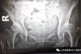 新泰市人民医院采用微创全髋关节置换治疗一名股骨头坏死患者图片