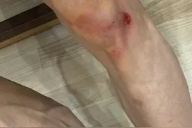 心疼！张一山运动摔伤腿 晒照自嘲上了年纪图片