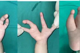 一岁半的孩子，手脚长得像“龙虾钳子”！父母奔赴千里来无锡求医图片