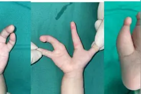 一岁半的孩子手脚像“龙虾钳子”，医生惊了图片