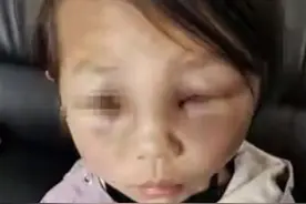 云南一女童遭怀孕继母虐打，当地妇联：已上门看望图片