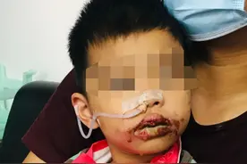 家长小心！福建南安5岁男孩误食管道疏通剂 口腔严重灼伤图片