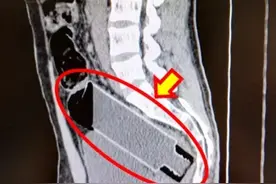 好奇害死猫，小伙子把水瓶塞进直肠，看肛肠科医生这些年取出的异物“从A到Z”有哪些图片