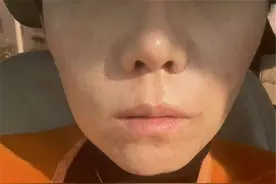 崩溃！女子花2万多元整容后，感觉自己整失败：眼睛“倒三角”，看起来又凶又老，下巴歪得更厉害了图片