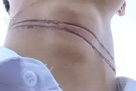 伤痕触目惊心！昆明外卖小哥骑车被风筝线“割喉”，现场放风筝者全数矢口否认图片