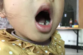 幼儿园孩子牙掉了，称午睡时动弹被老师拍了两下，老师回应：只是隔着被子拍了背部以下图片